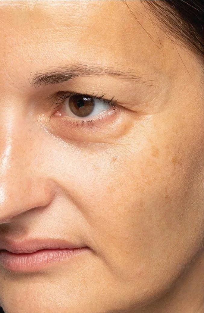 Fine lines around the eye