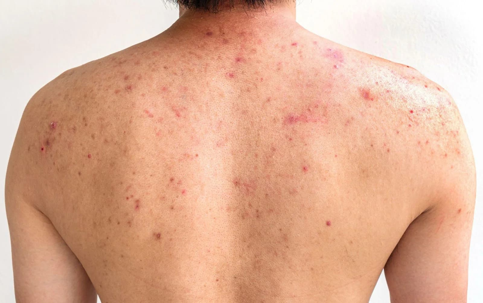 Back blemishes and acne concerns