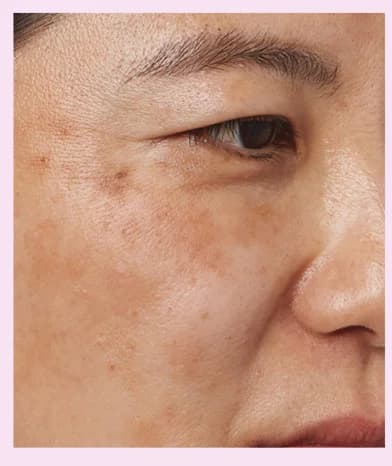 Dark spots and uneven skin tone