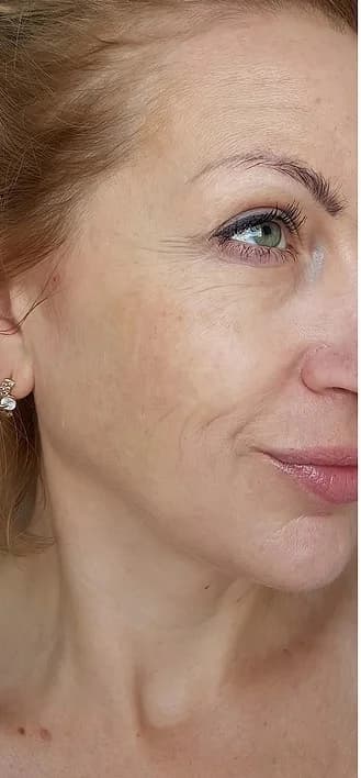 Facial fine lines and wrinkles