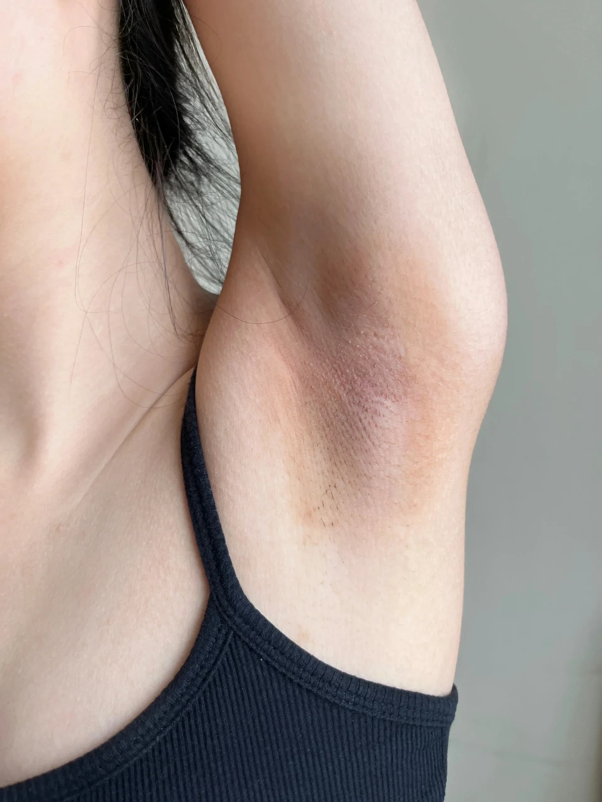 Uneven underarm skin tone