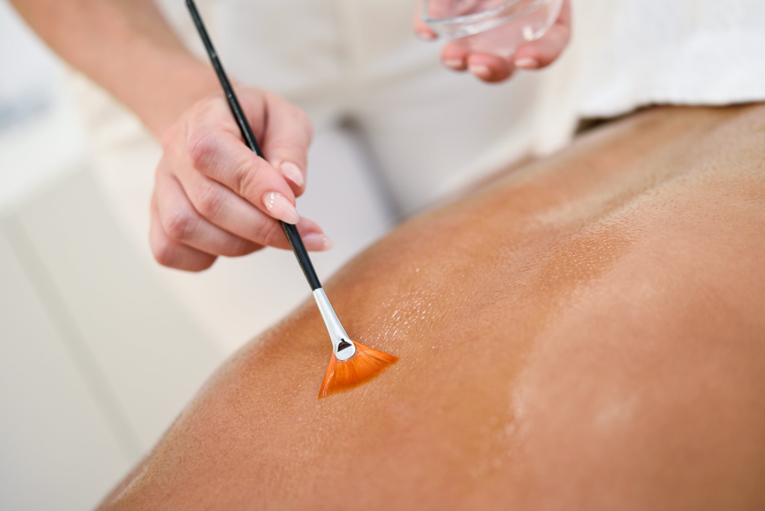 A professional uses a soft brush to apply a treatment to a person's back, symbolizing the gentle approach that should be taken to avoid irritating acne-prone skin.