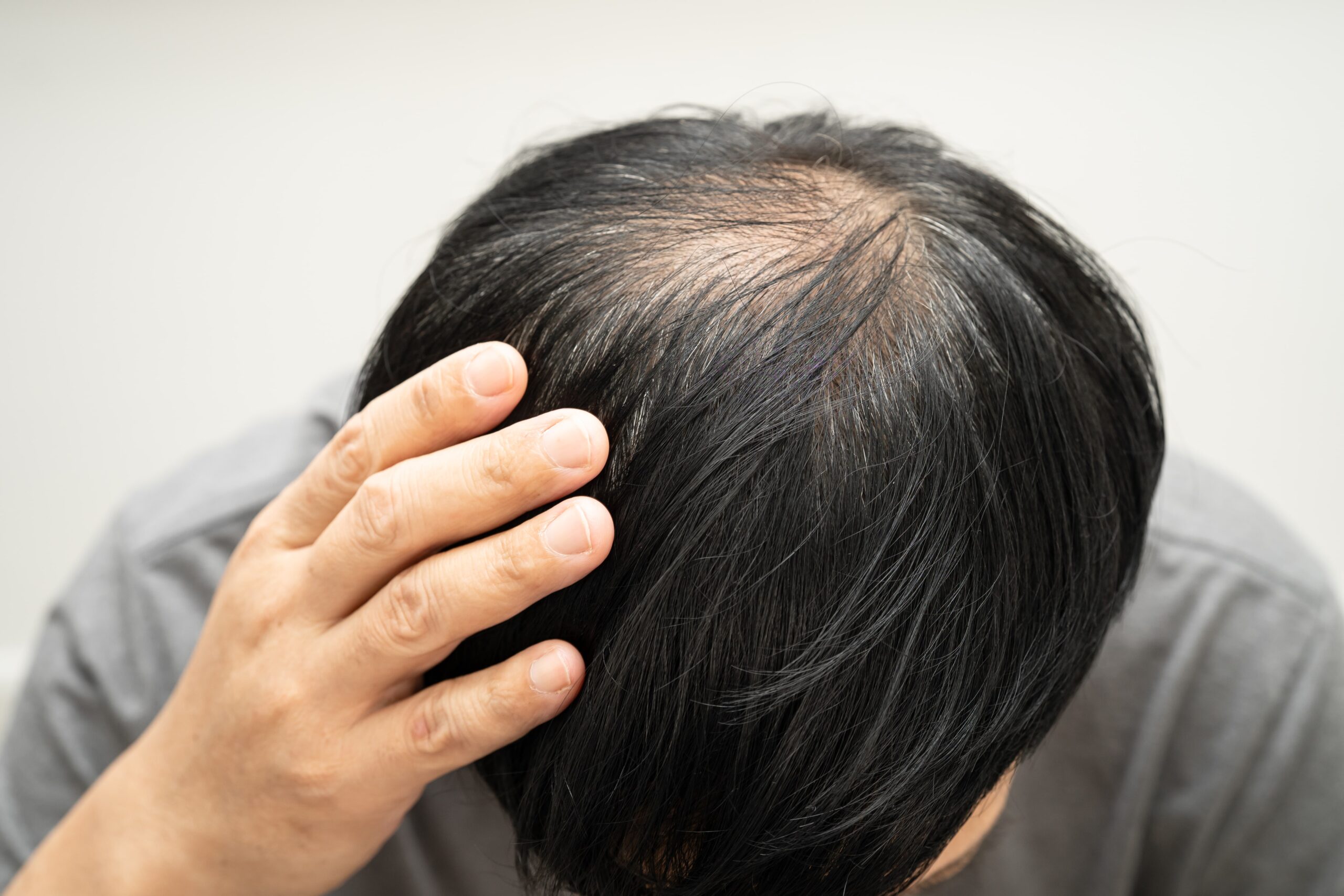 A close-up shot of a person's scalp showing noticeable hair thinning and a balding spot, representing a common hair loss problem.