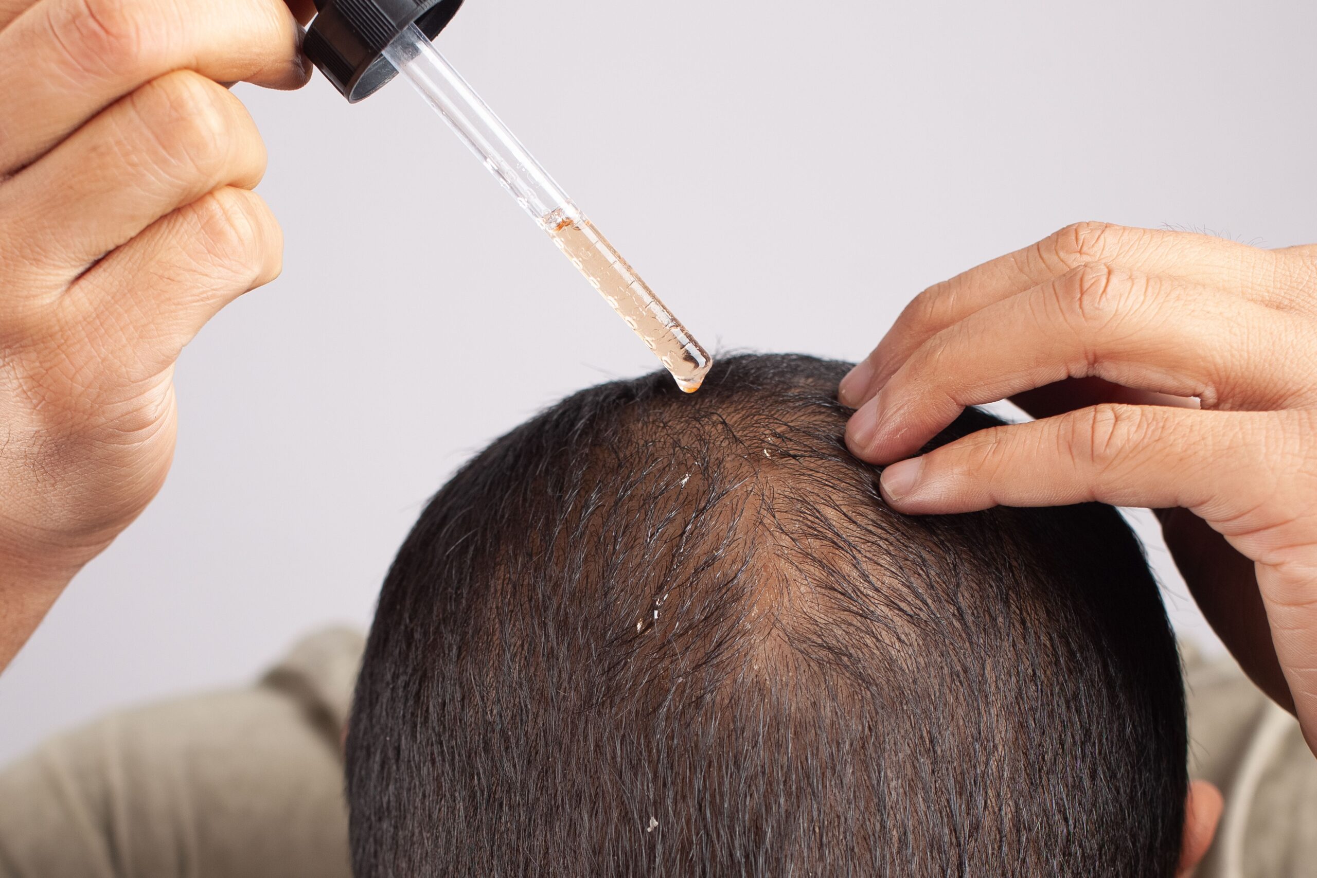 A person applies a hair growth serum with a dropper to a thinning spot on their scalp, showing a targeted treatment step in a complete hair loss care routine.