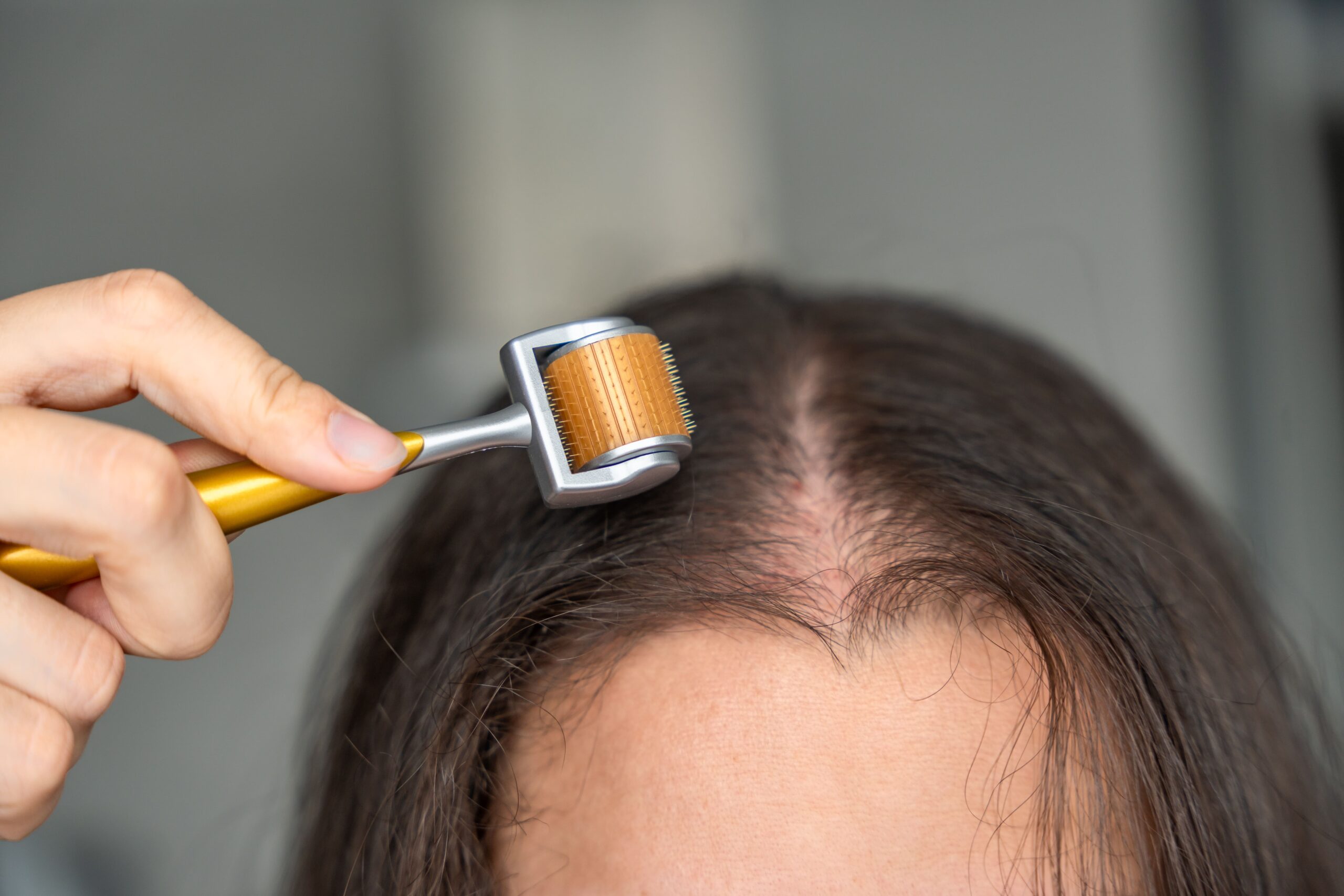 A person uses a derma roller on their scalp to stimulate hair follicles, representing an advanced tool in a complete hair care routine for hair loss.