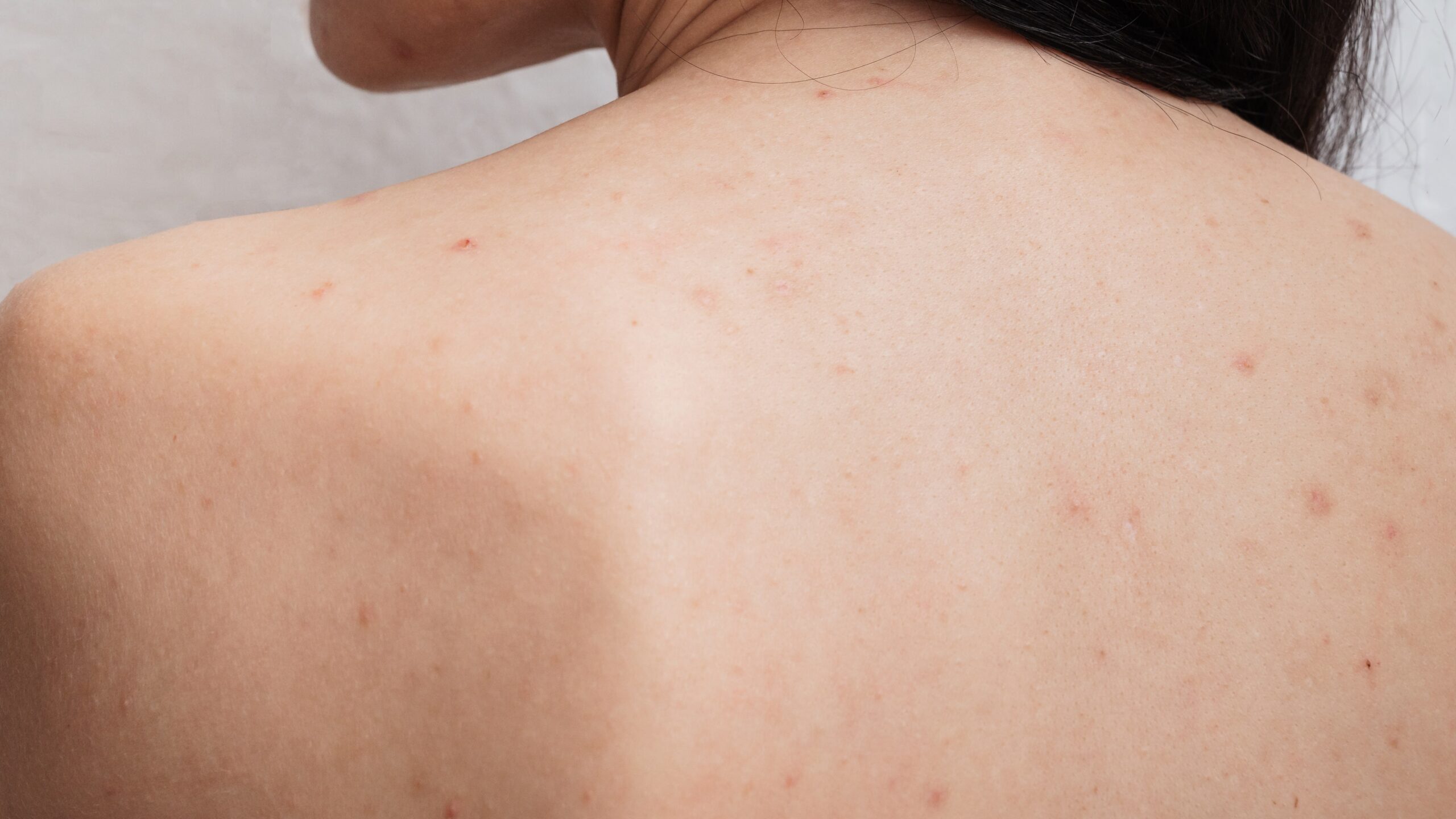 A close-up shot of a person's upper back with visible red spots and acne, illustrating the common issue of 'bacne' or back acne.